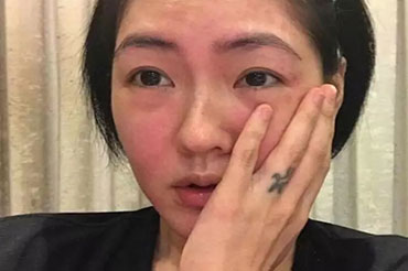 換季皮膚過敏怎么辦？六大致敏誤區(qū)!